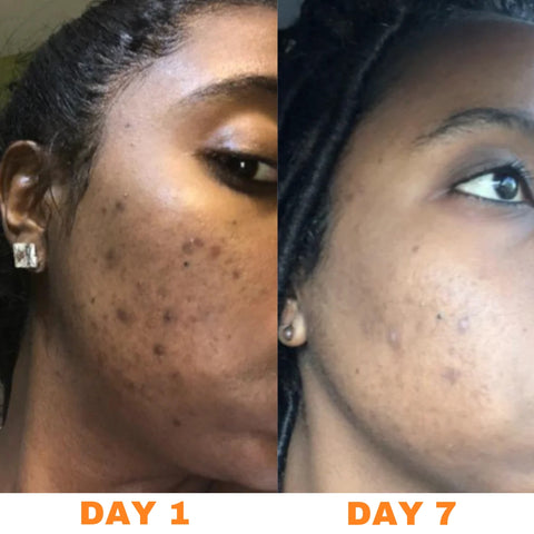 Vitamin C Face Serum | Fade Acne Marks + Hyperpigmentation